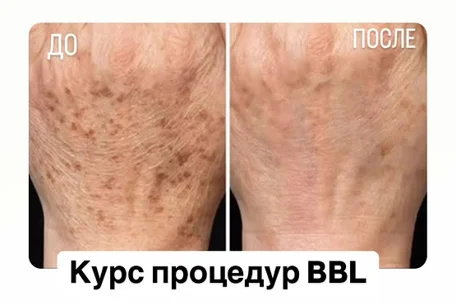 Эффективная BBL-терапия в клинике Tulip Medicine. До и после, показания, цены на омоложение, очищение кожи и удаление волос.