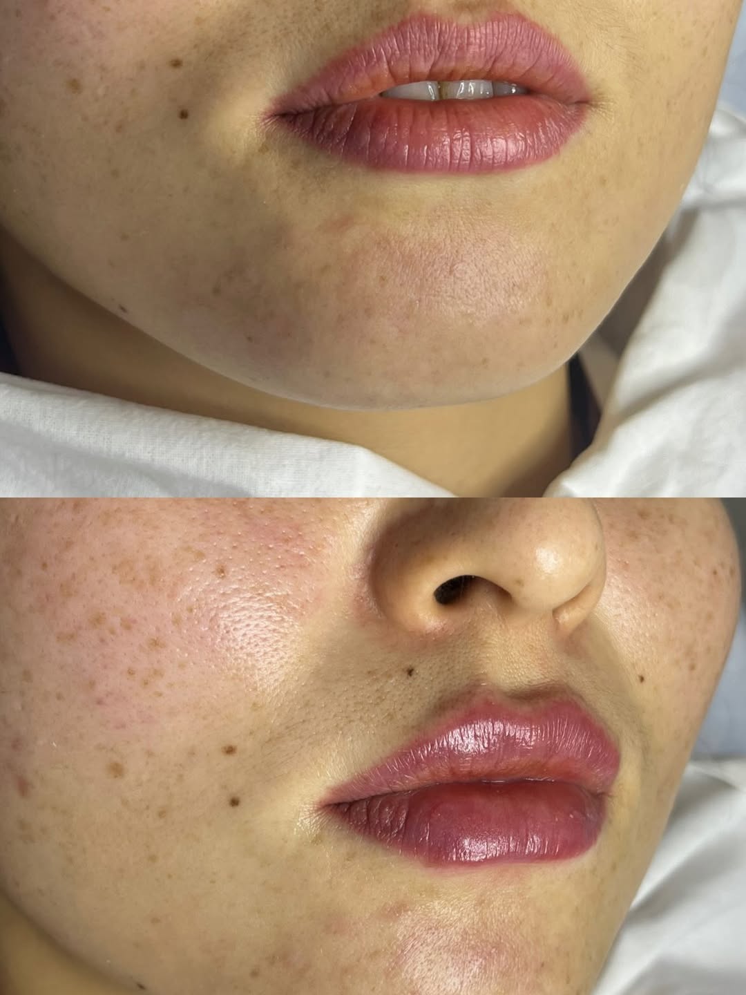 Биоревитализация губ в Астане без “перекачивания”: увлажнение, мягкость и уход. Hyalrepair LIPS 1 ml и цена по прайсу.