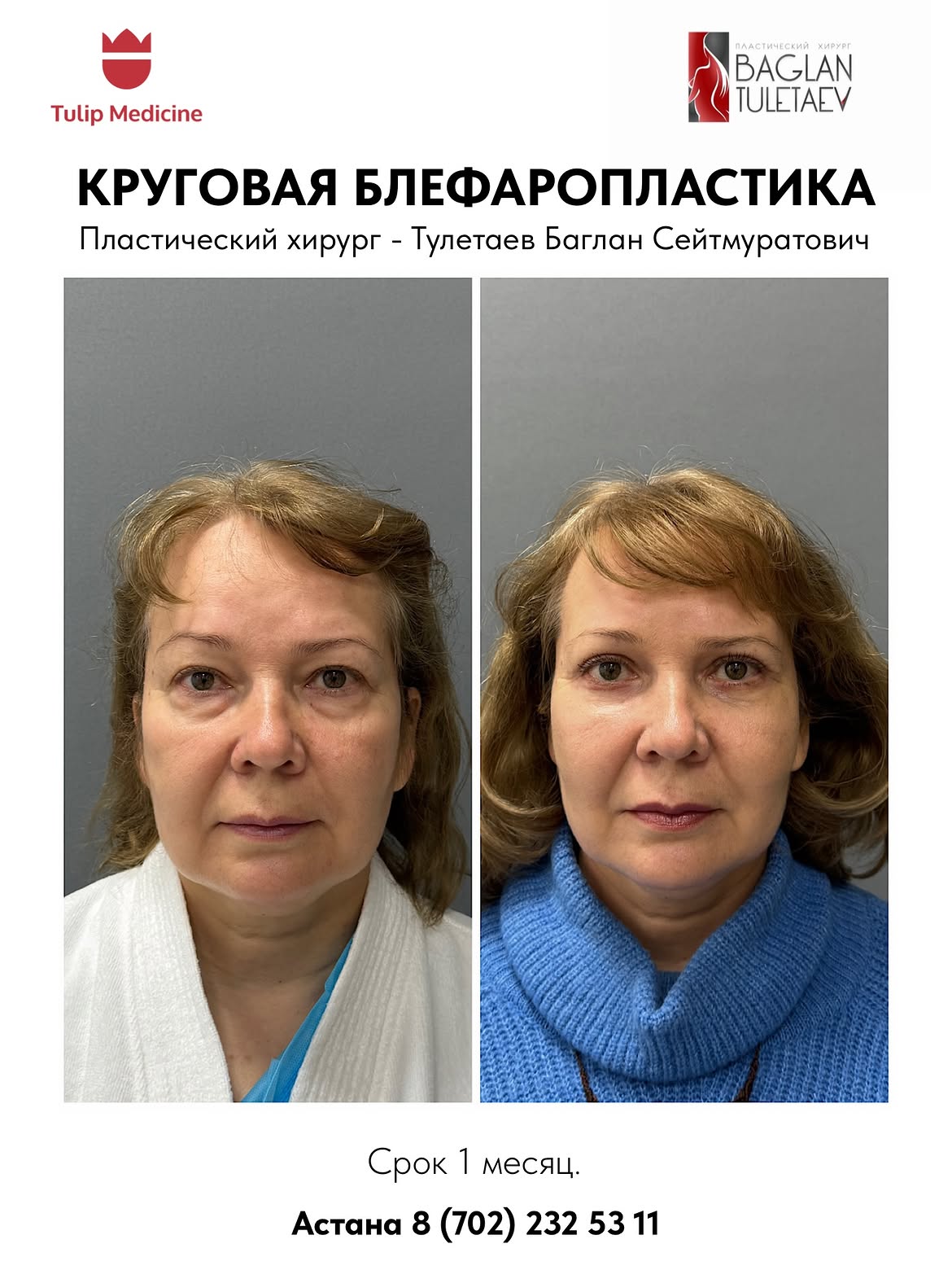 Блефаропластика в Казахстане: лучшие хирурги, цены, фото до и после, результаты 4 Блефаропластика в Казахстане — современное решение для коррекции нависших век, мешков под глазами и возрастных изменений. Цены, результаты, отзывы и консультация хирурга.