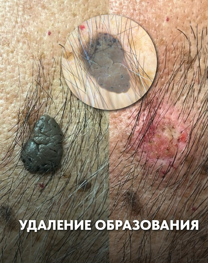 Дерматохирург в Астане — диагностика и удаление новообразований кожи