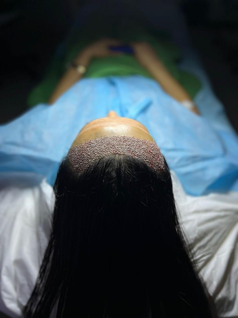 Экзосомы в Астане — помощь при алопеции 2 Экзосомы в Астане от выпадения волос — инновация, одобренная трихологами. Улучшает микроциркуляцию и стимулирует рост новых волос.