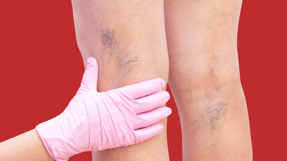 ЭВЛК в Алматы в клинике Tulip Medicine: малоинвазивное лазерное лечение варикоза без разрезов, госпитализации и длительной реабилитации.