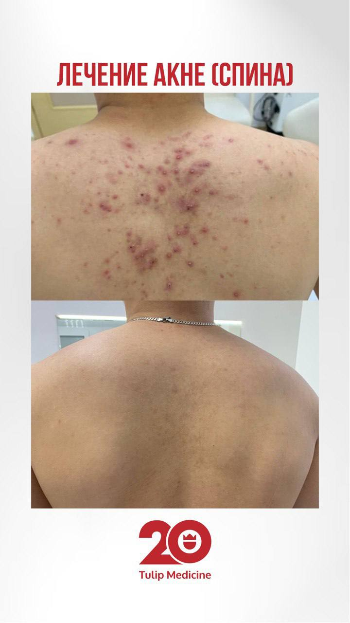 Лечение акне спины в Астане 1 Акне спины часто сопровождается болезненными воспалениями. В Астане, в клинике Tulip Medicine, применяют щадящие, но эффективные методы терапии.