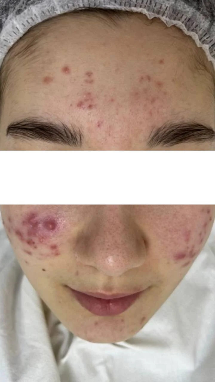 Конглобатное акне в Астане: когда «обычные прыщи» уже не норма