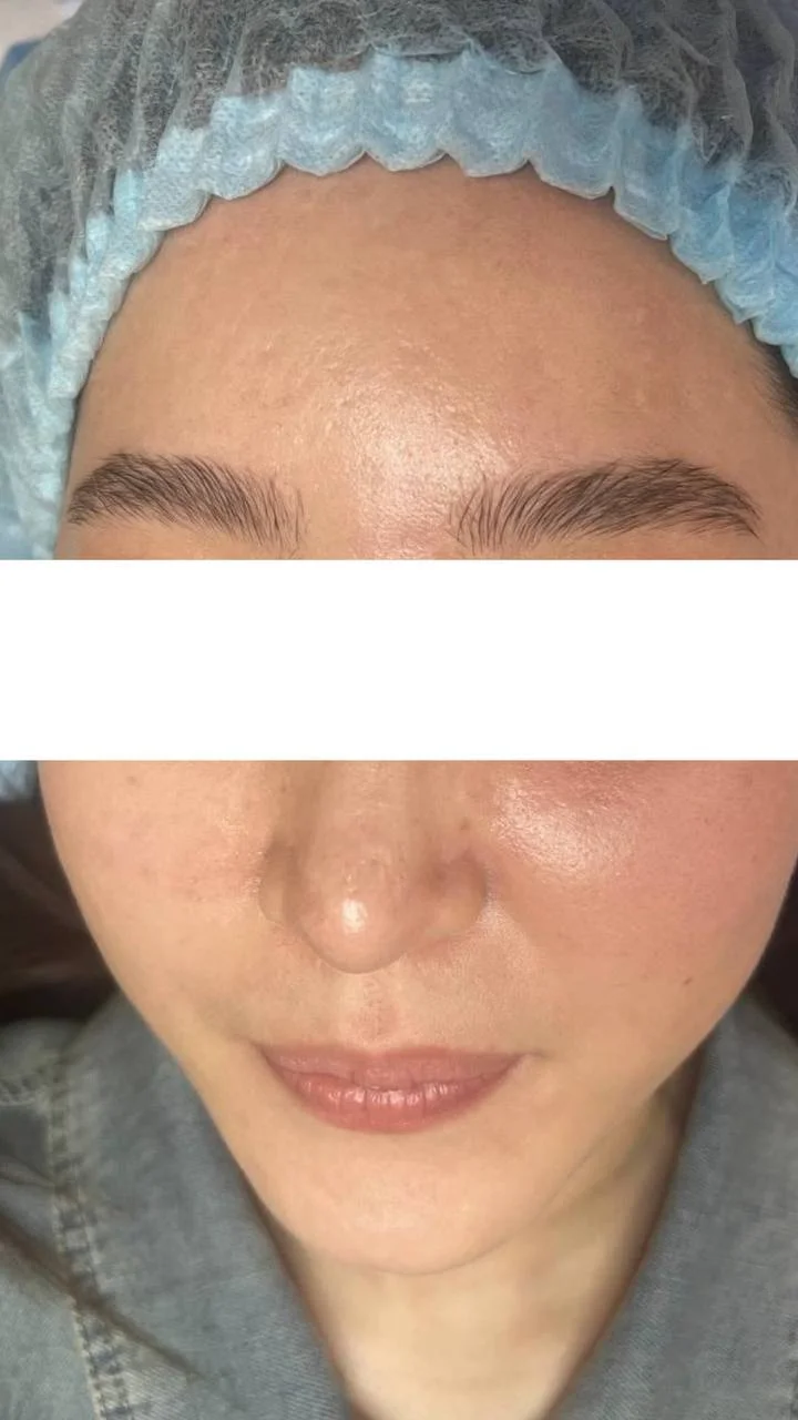 Конглобатное акне в Астане: когда «обычные прыщи» уже не норма