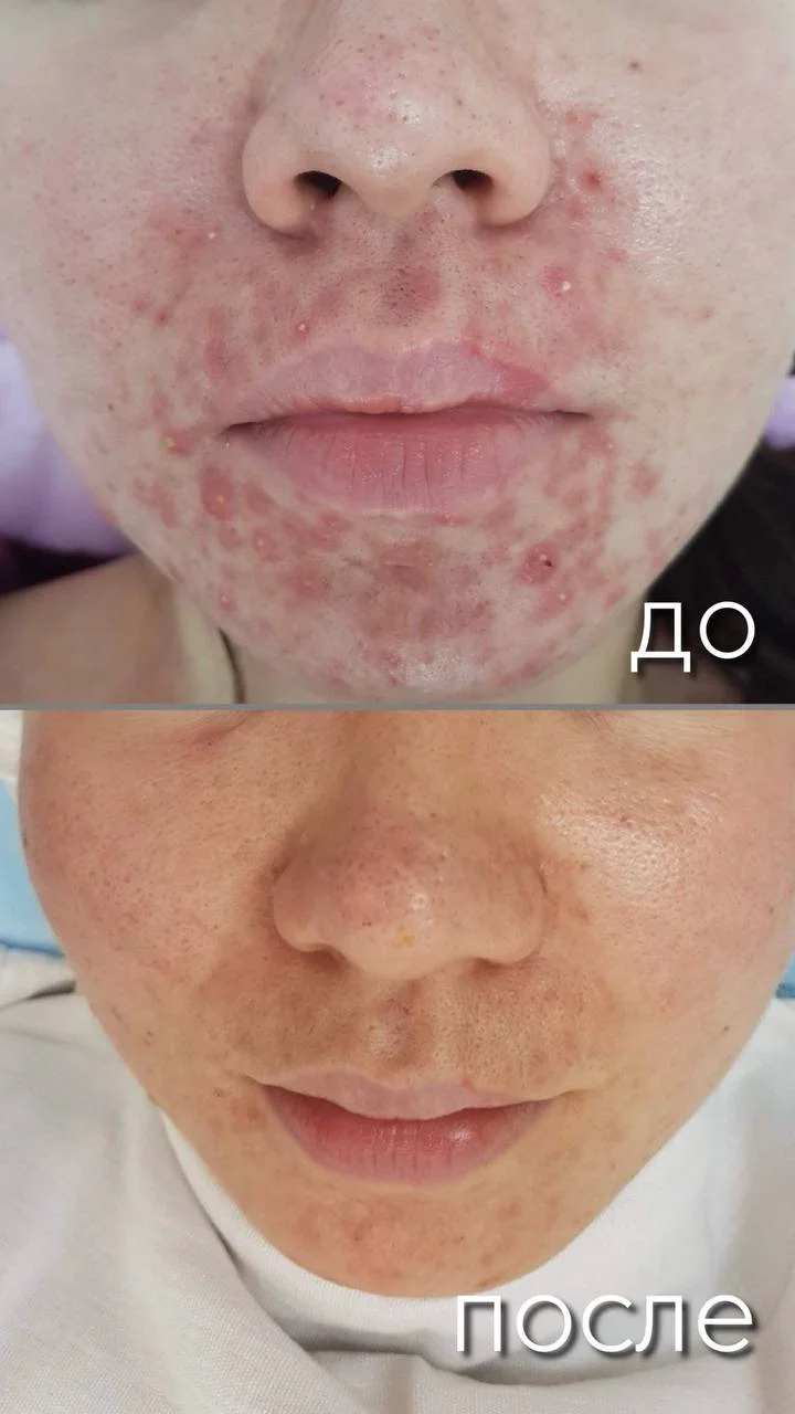 Конглобатное акне в Астане — тяжёлая форма акне с узлами, кистами и рубцами. Рассказываем, как проходит диагностика, лечение системными ретиноидами и уход за кожей в клинике.