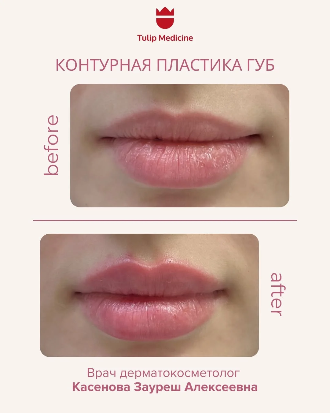 Ищете контурную пластику лица в Алматы? Коррекция губ, скул, овала лица и носогубных складок в Tulip Medicine.