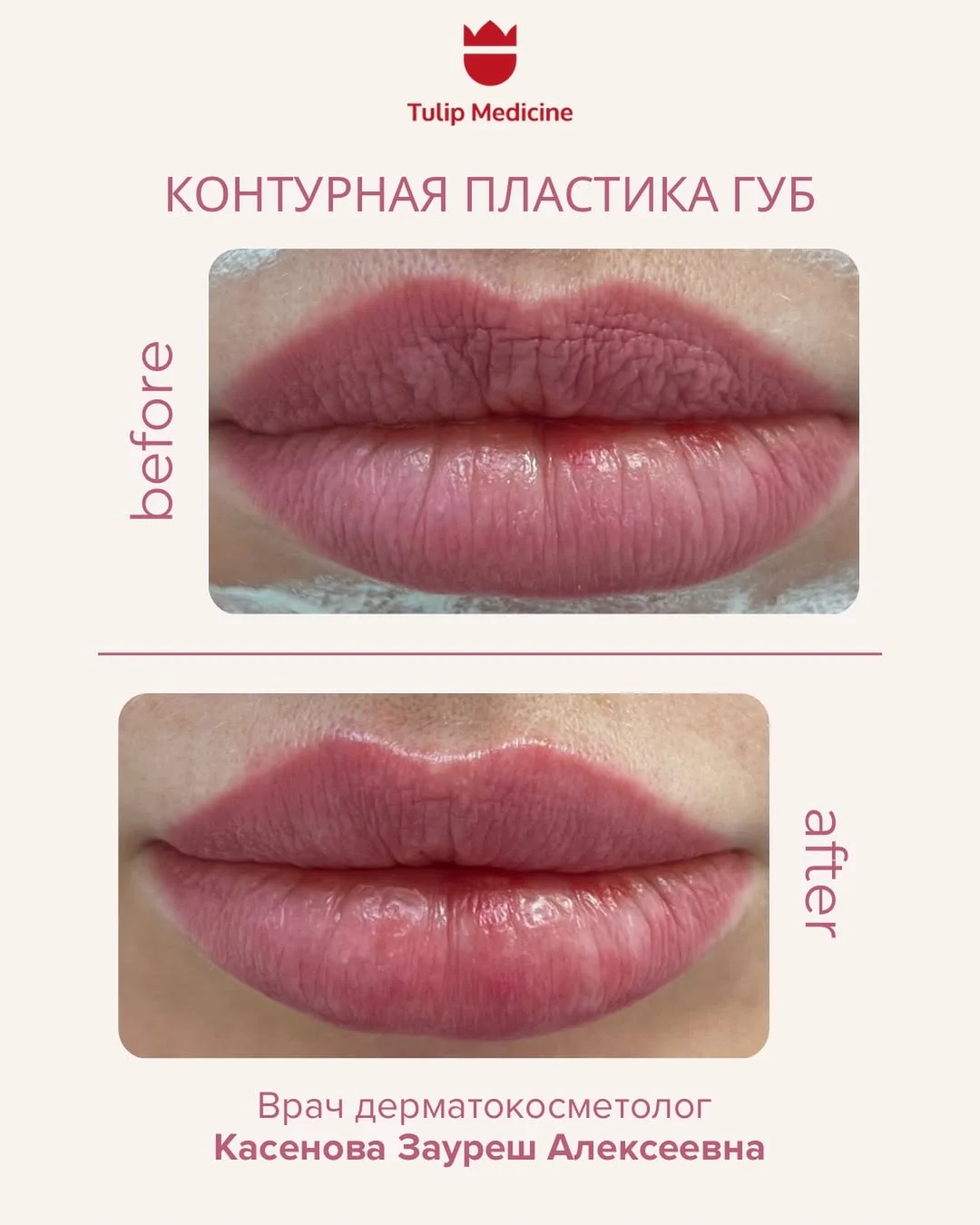 Контурная пластика лица в Алматы с естественным результатом без операции. Сертифицированные филлеры и опытные специалисты.