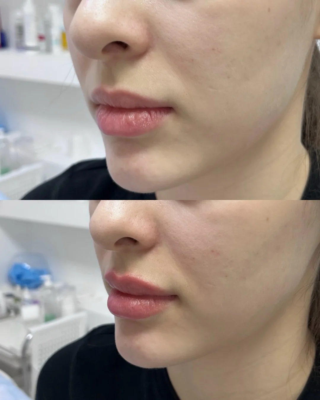 Контурная пластика лица в Астане: цены, отзывы и результат 3 Контурная пластика лица в Астане: какие зоны можно скорректировать, сколько держится результат, от чего зависит цена и как выбрать процедуру.