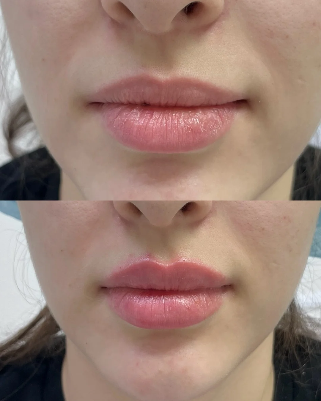 Контурная пластика лица в Астане: цены, отзывы и результат 4 Контурная пластика лица в Астане в Tulip Medicine: скулы, подбородок, носогубные складки, цены, отзывы и запись на консультацию.