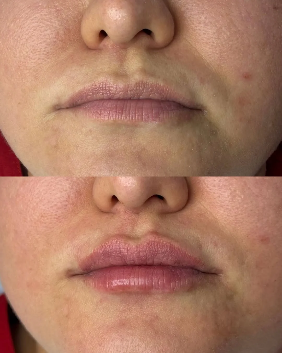 Контурная пластика лица в Астане: цены, отзывы и результат 6 Узнайте, как проходит контурная пластика лица в Астане, кому она подходит, сколько стоит коррекция и когда виден окончательный результат.