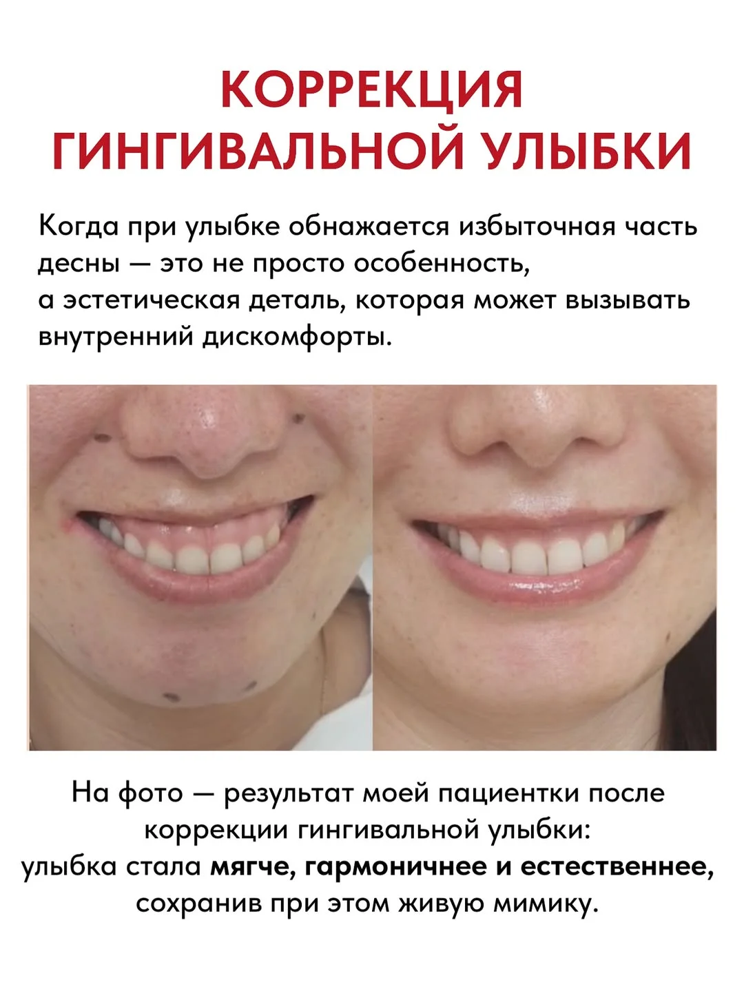 Ботокс при десневой улыбке в Алматы: кому подходит процедура, когда виден результат, какие есть ограничения и сколько держится эффект.