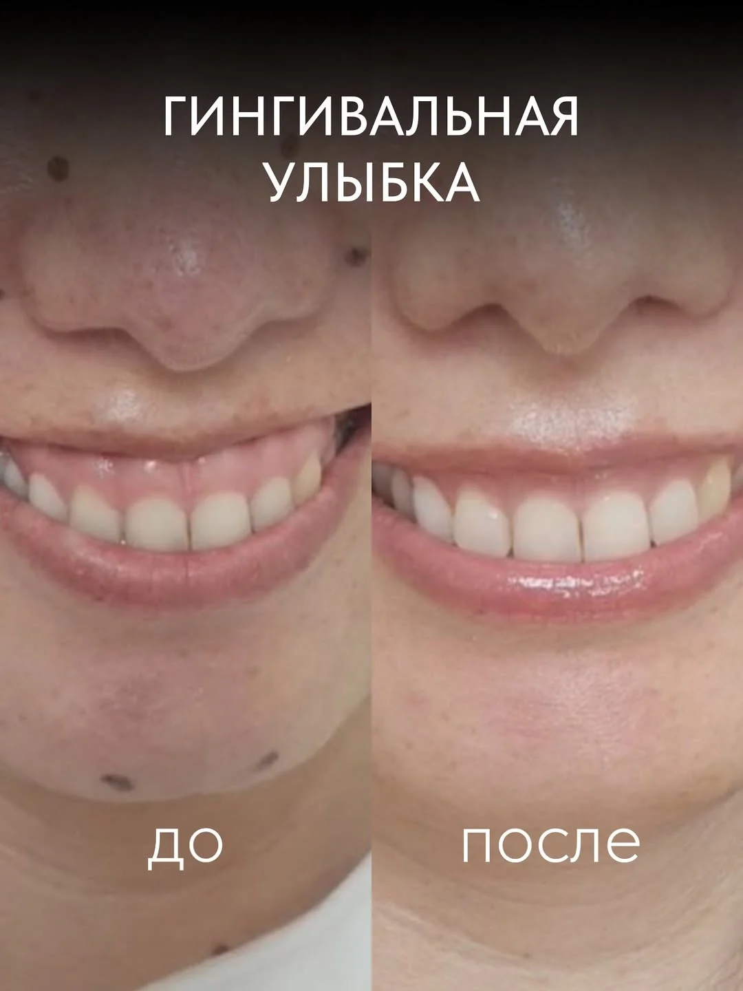 Гингивальная улыбка в Астане: разбираем причины, методы коррекции, сроки результата и когда возможна коррекция без операции.