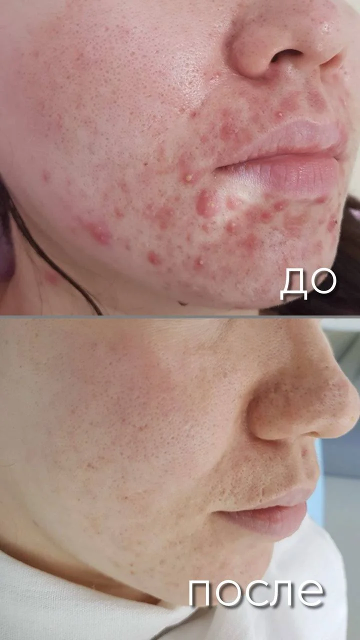 Лазерное лечение акне в Астане — доказательный подход Tulip Medicine 1 ChatGPT said:
Лазерное лечение акне в Астане — современный метод Tulip Medicine, направленный на устранение воспалений, сужение пор и выравнивание кожи без травм.