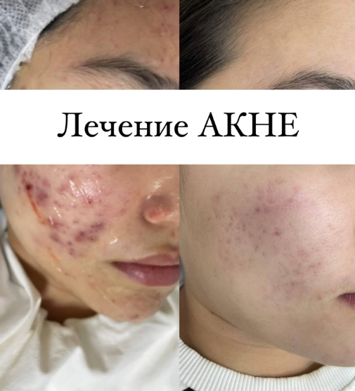 Комплексное лечение акне в Казахстане от Tulip Medicine (фото до-после) — это сочетание международных клинических рекомендаций и собственного дерматологического опыта.