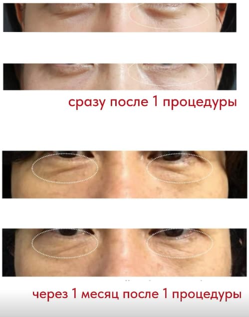 Liftera в Астане — SMAS-лифтинг нового поколения с клинической базой 2 Фото до-после SMAS-лифтинг Liftera в Астане — сфокусированный ультразвук для подтяжки овала и шеи. Комфортно, без реабилитации. Узнайте, показана ли вам.