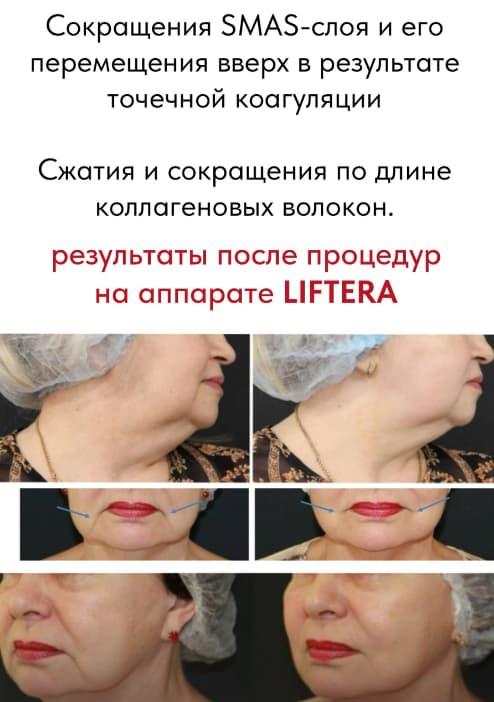 Liftera в Астане — SMAS-лифтинг нового поколения с клинической базой 3 Хотите чёткий овал без операций? Liftera (SMAS-лифтинг) в Астане: безопасно, комфортно, результат до 12–18 месяцев. Консультация врача.