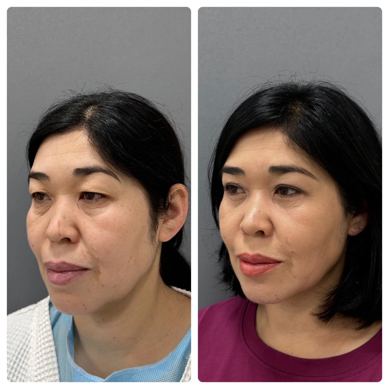 Липофилинг в Казахстане: естественный объём без имплантов 2 Липофилинг в Казахстане: современный метод моделирования фигуры и омоложения лица. Заполнение морщин собственным жиром и коррекция атрофических рубцов.