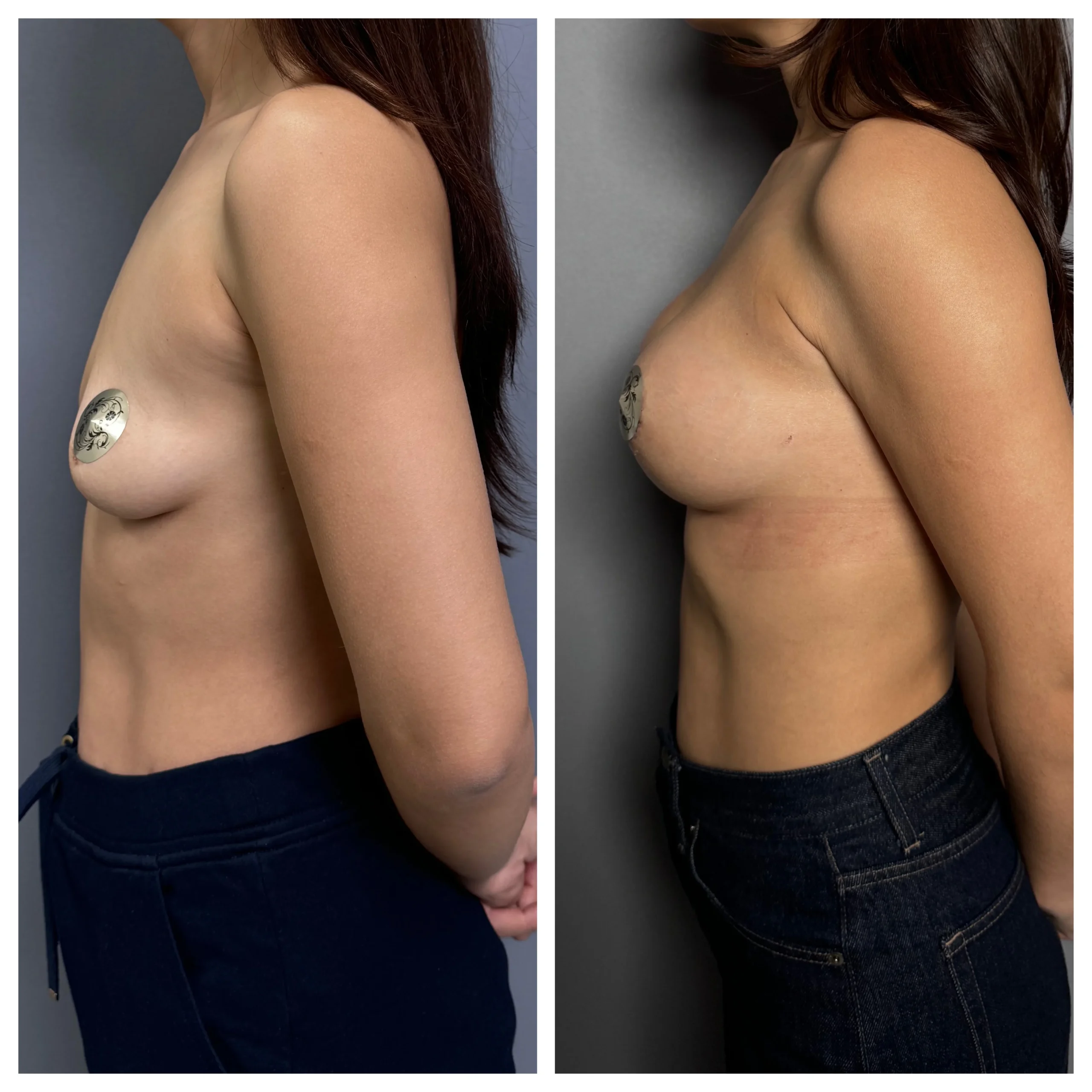 Липофилинг в Казахстане: естественный объём без имплантов 1 Липофилинг в Казахстане от опытных пластических хирургов: закачивание жира в ягодицы, мягкое увеличение груди и восстановление объёма лица без имплантов.