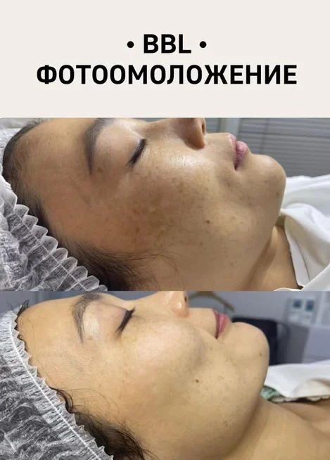 BBL — фототерапия нового поколения. Убирает купероз, пигментацию, акне. Подходит для всех типов кожи, в любое время года.