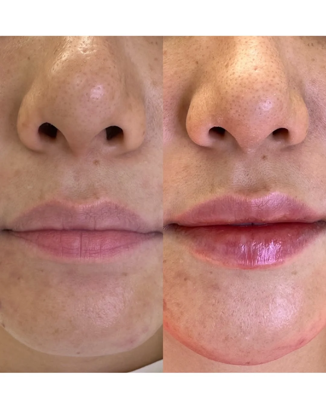 Инъекционное омоложение в Алматы: биоревитализация, ботулинотерапия, филлеры — что входит в протокол и как формируется стоимость.