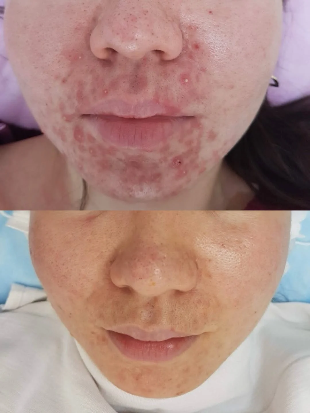 Фото «до/после» при омоложении: как правильно оценивать эффект и почему важны одинаковый свет, ракурс и сроки.