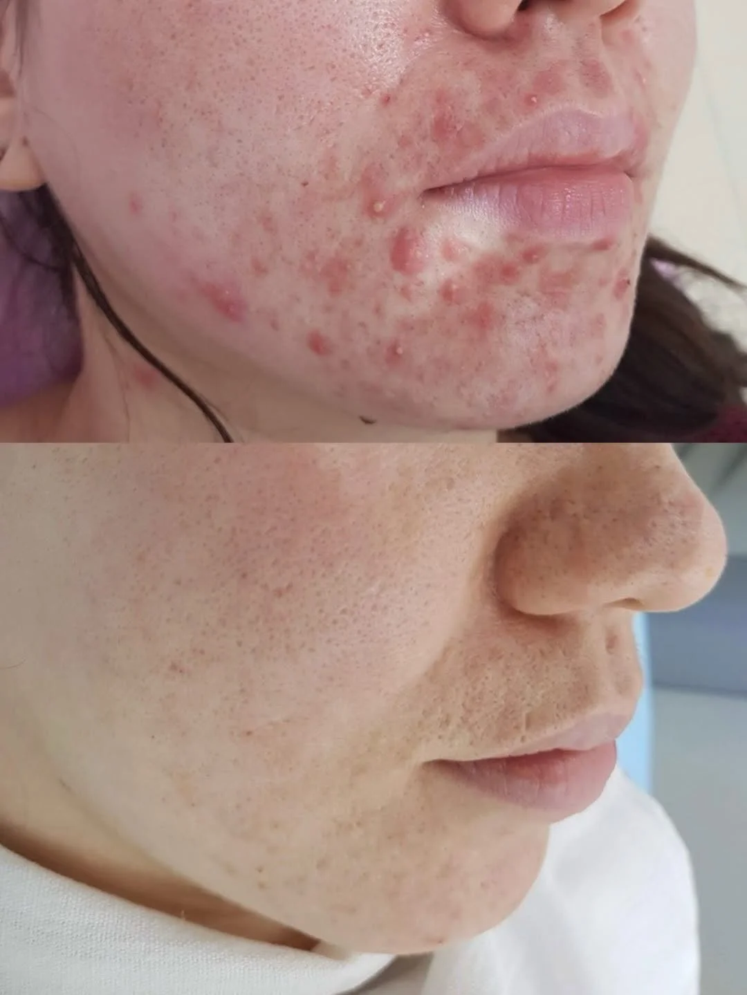 Омоложение кожи лица в Алматы: инъекции, BBL и RF-лифтинг — показания, этапы, цены