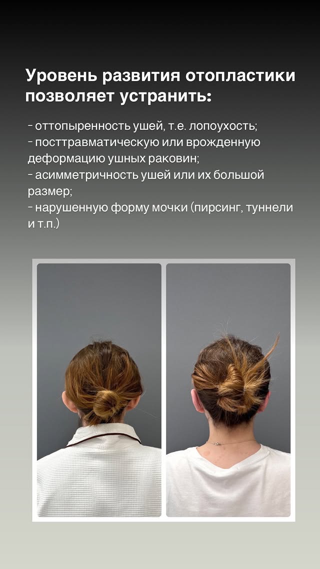 Узнайте, сколько стоит отопластика в Астане. Коррекция ушей 1 и 2 категории сложности, повторные операции и пластика мочек — прайс 2025 года.