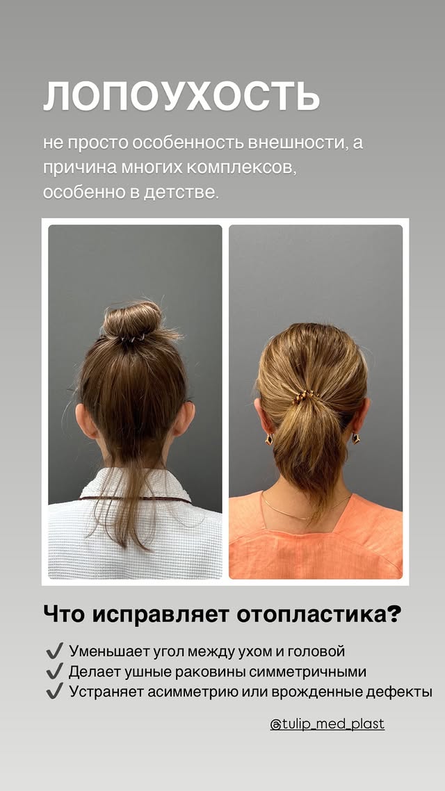 Все цены на отопластику в одном месте: пластика ушных раковин, устранение лопоухости, повторные операции и пластика мочек — клиника Tulip Medicine.