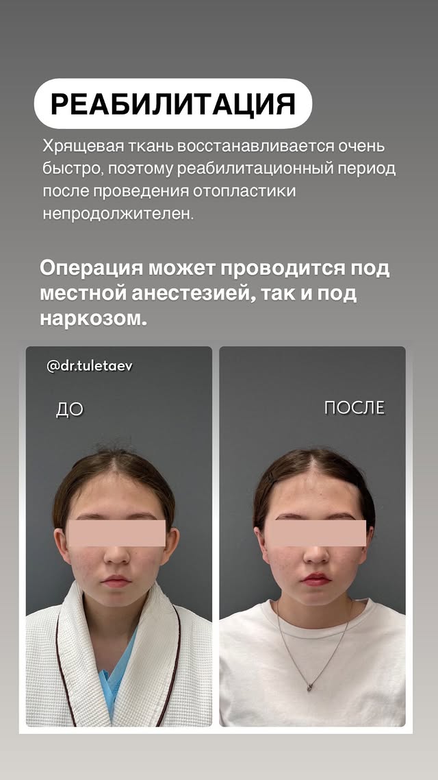Узнайте, сколько стоит отопластика в Астане. Коррекция ушей 1 и 2 категории сложности, повторные операции и пластика мочек — прайс 2025 года.