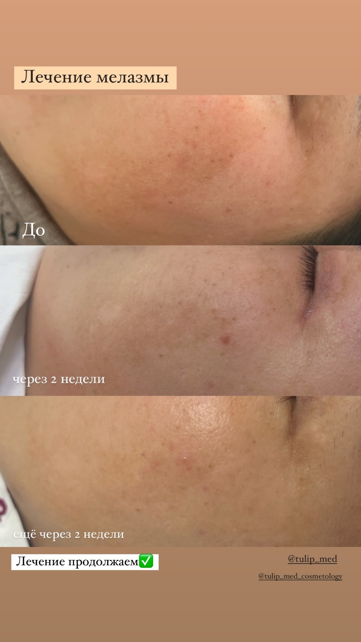 Лечение пигментации в Алматы начинается с понимания причины. В статье рассказываем, когда помогают BBL, лазер, пилинги и мезотерапия при пигментации.
