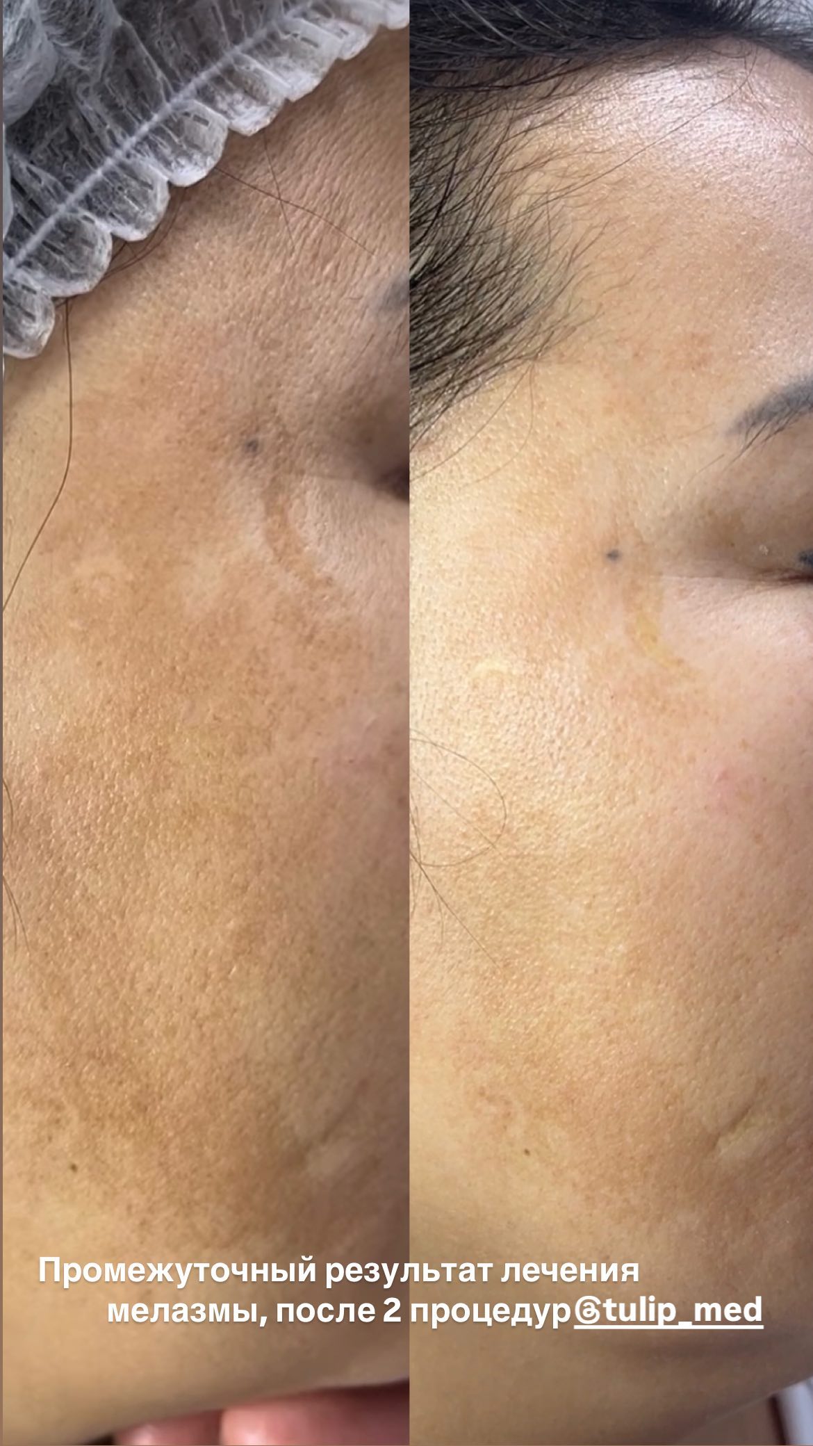 Пигментация лица в Алматы требует точной диагностики и комплексного лечения. Узнайте, какие методы применяют при мелазме, постакне и пятнах после солнца.