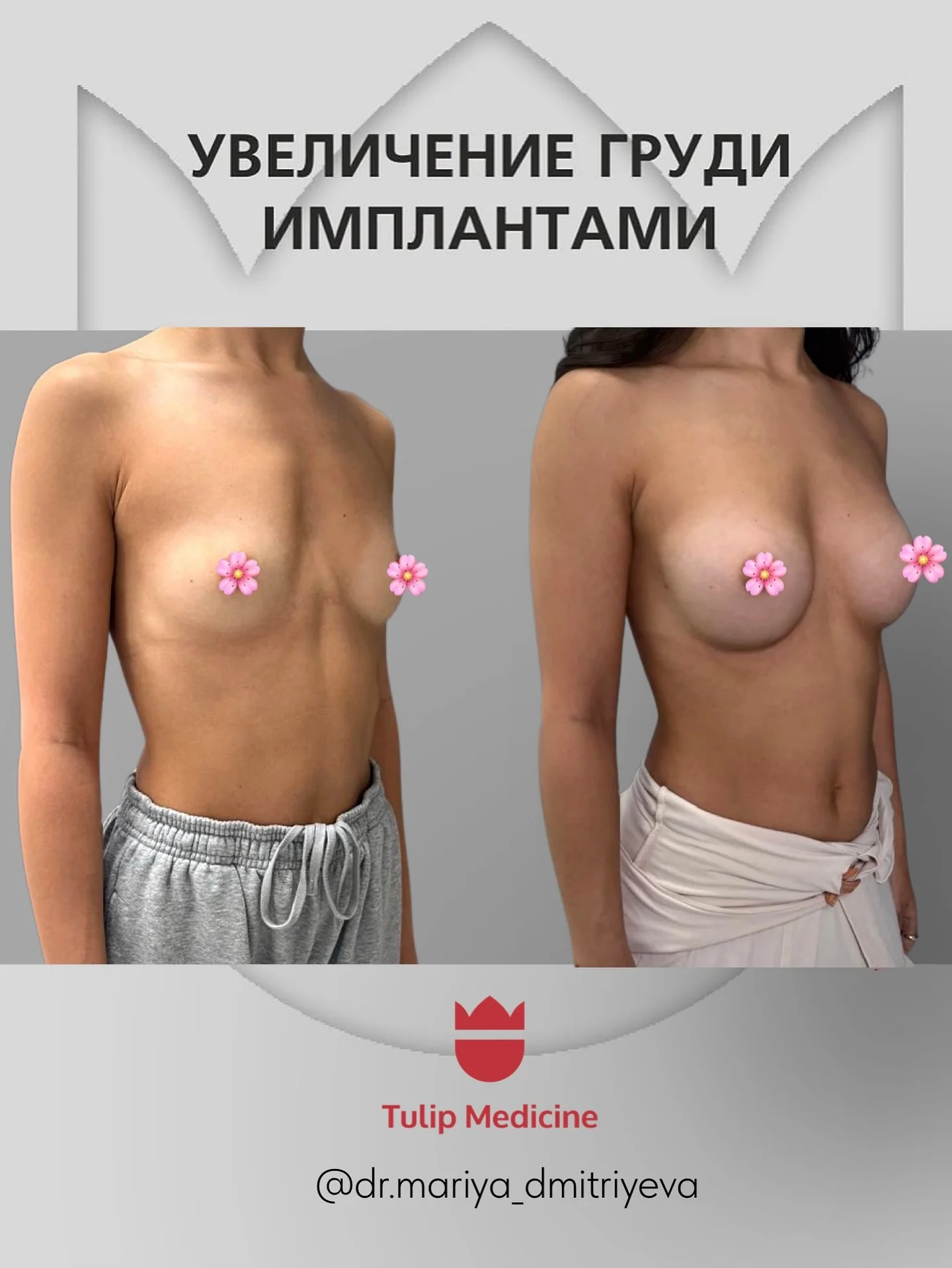 Пластическая хирургия в Астане: операции на лице, груди и теле в Tulip Medicine 3 Пластическая хирургия в Астане в Tulip Medicine: операции на лице, груди и теле, опытные пластические хирурги, актуальные цены и консультация.