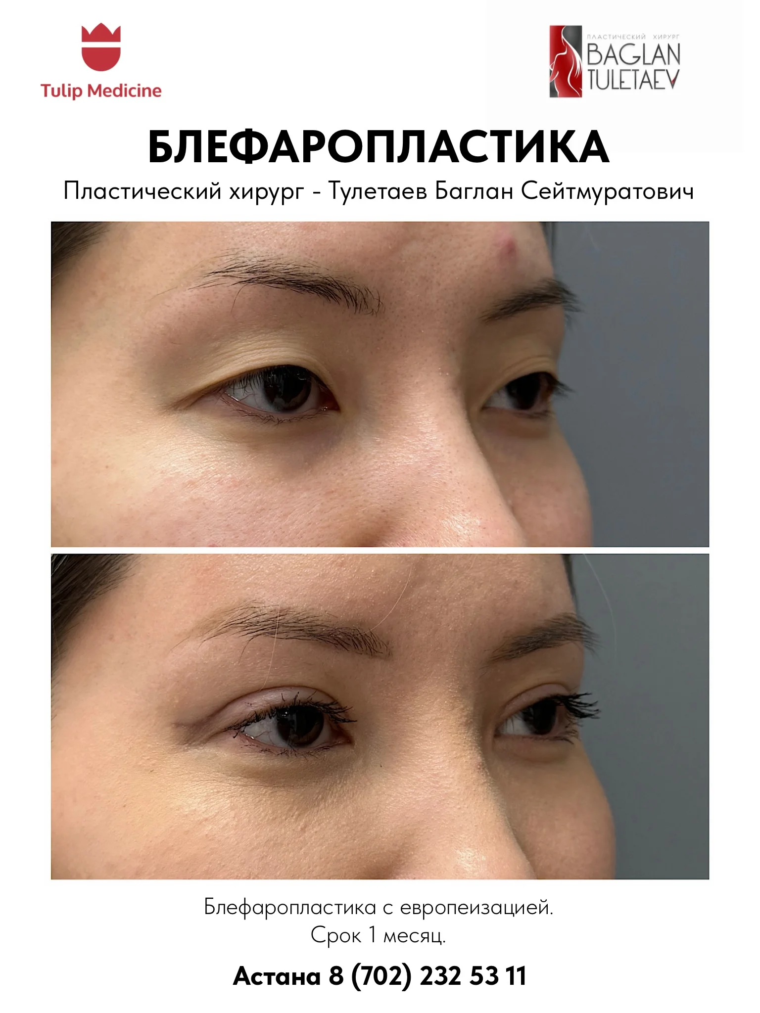 Пластическая хирургия в Астане: операции на лице, груди и теле в Tulip Medicine 2 Пластическая хирургия в Астане с индивидуальным планированием операции. Врачи Tulip Medicine, цены, направления и этапы подготовки.