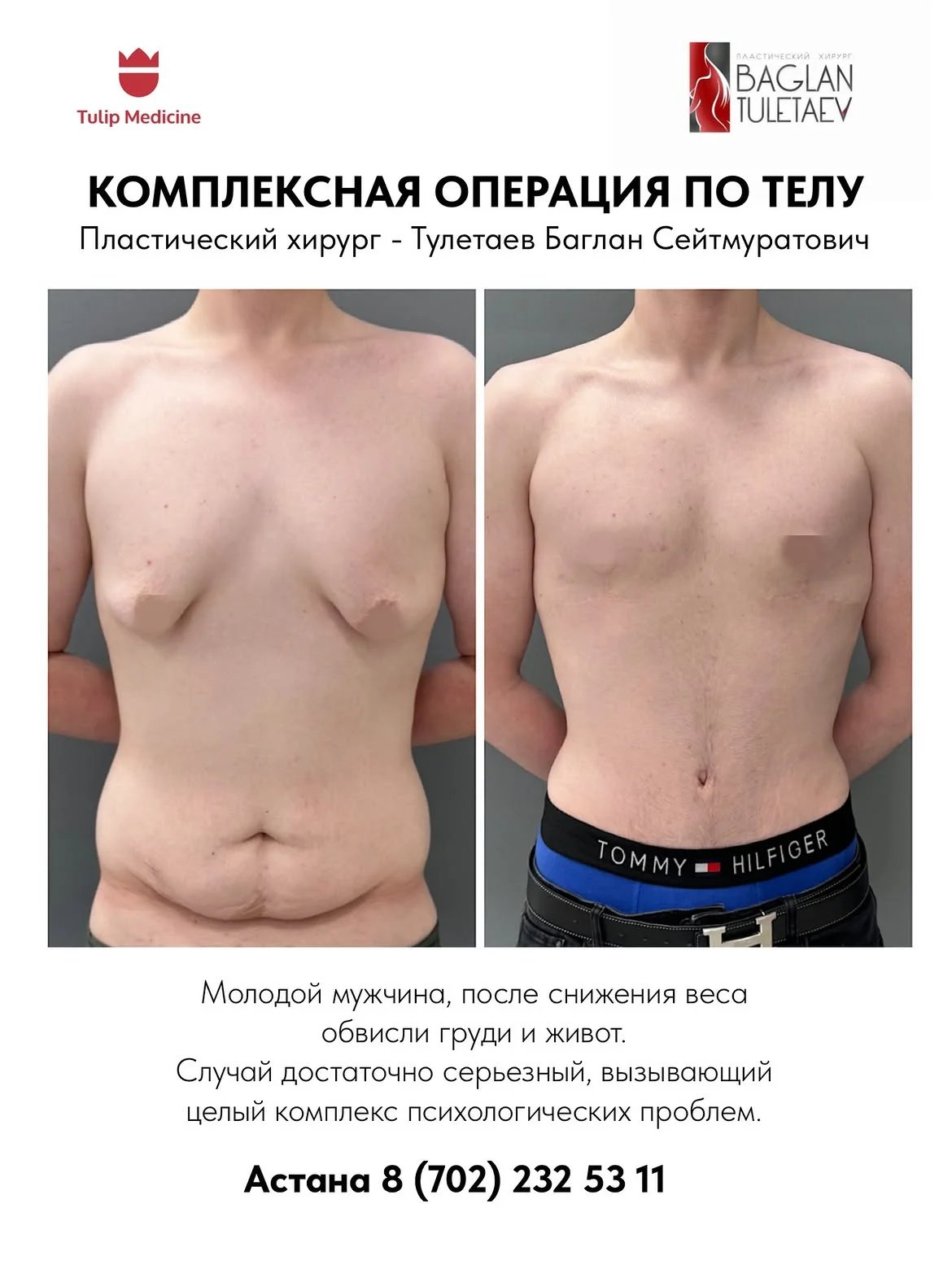 Пластическая операция после снижения веса в Астане в Tulip Medicine: индивидуальный план, поэтапное лечение, коррекция лишней кожи и контуров тела.