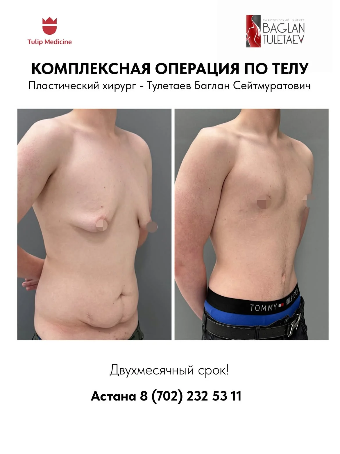 Пластическая операция после снижения веса в Астане: как убрать лишнюю кожу, восстановить контуры тела и составить хирургический план в Tulip Medicine.