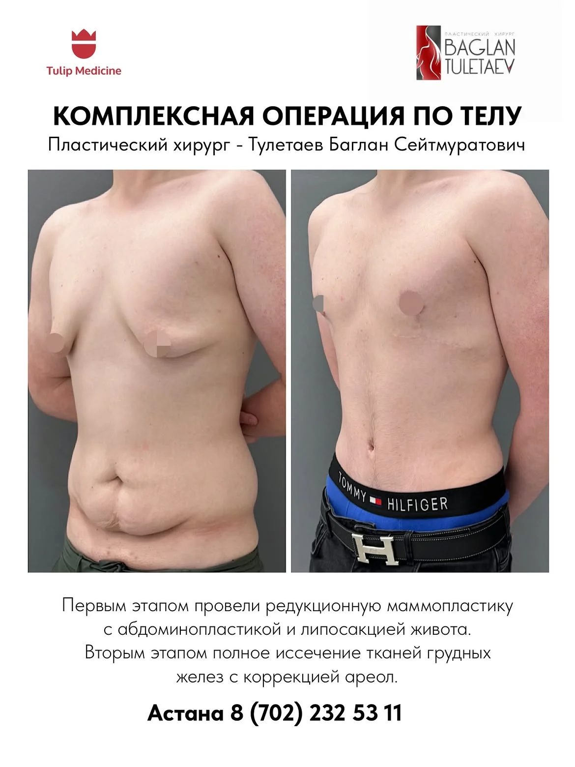 Пластическая операция после снижения веса в Астане: комплексная коррекция тела, удаление кожного фартука, подтяжка груди и липосакция по показаниям.