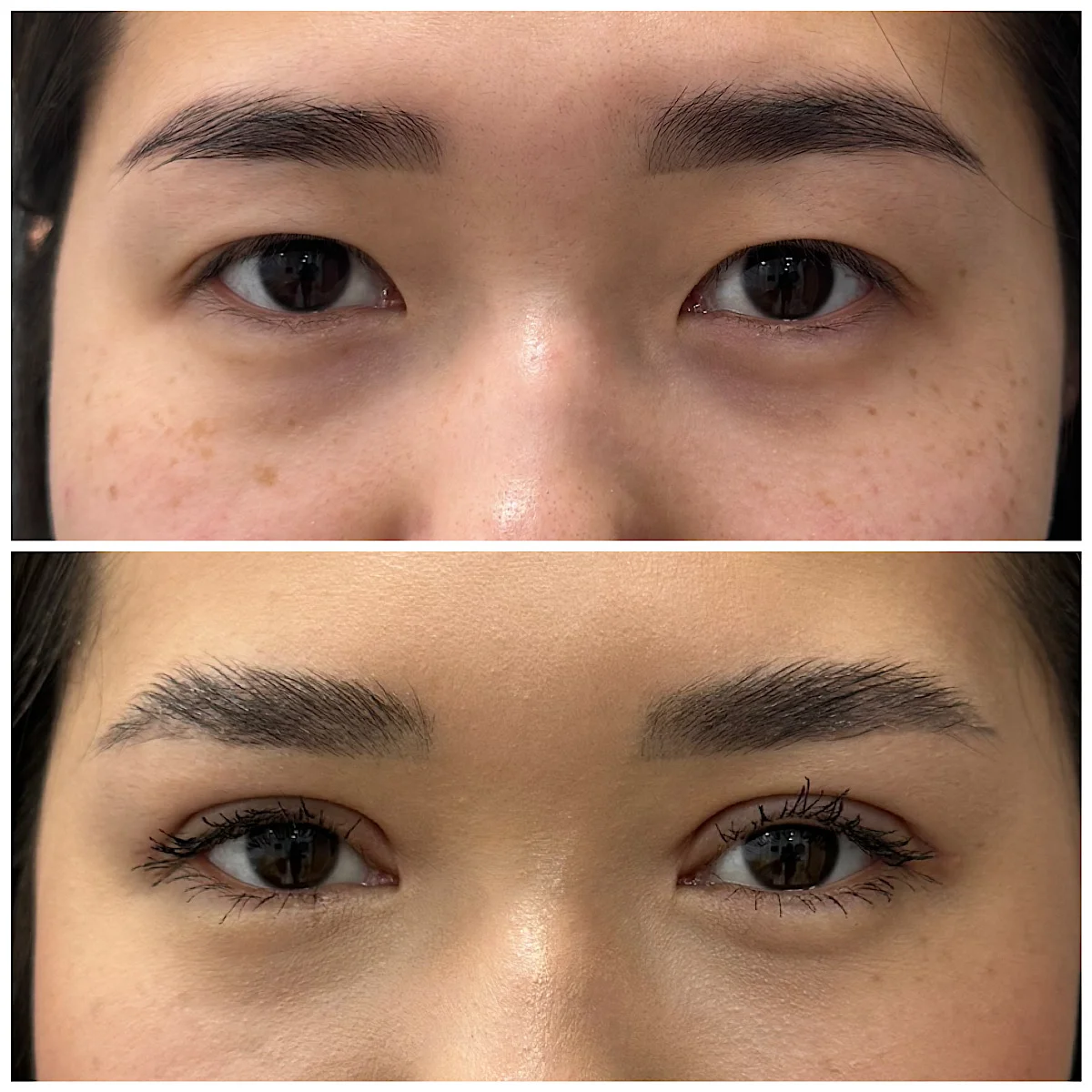 Пластика век в Астане: верхняя, нижняя и трансконъюнктивальная — чем отличаются методы, кому подходят, сколько стоит и какой результат реально ожидать.