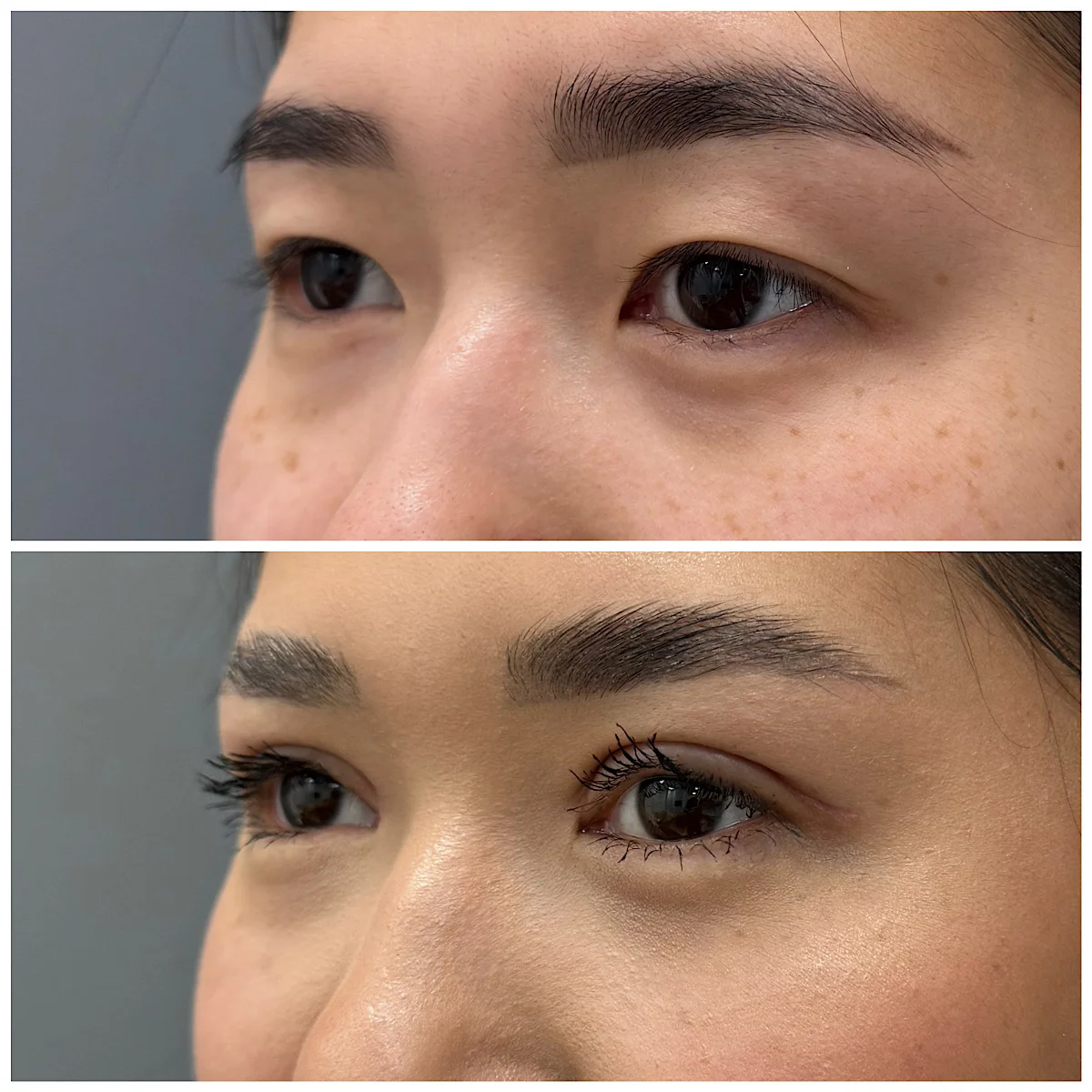 Пластика век цена в Астане: ориентиры по прайсу, что влияет на итоговую стоимость, нужна ли кантопексия и как проходит консультация хирурга.