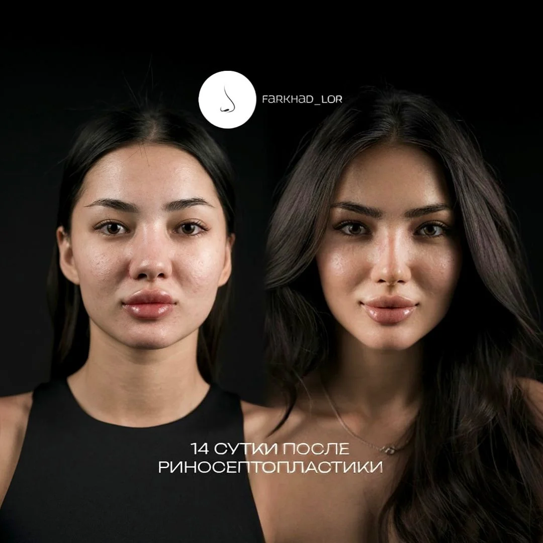 Повторная септопластика в Астане и Алматы: когда имеет смысл делать операцию ещё раз 1 Ресептопластика в Казахстане — сложная ревизионная операция для тех, у кого после первой септопластики сохранились жалобы и требуется повторная операция на носовой перегородке.