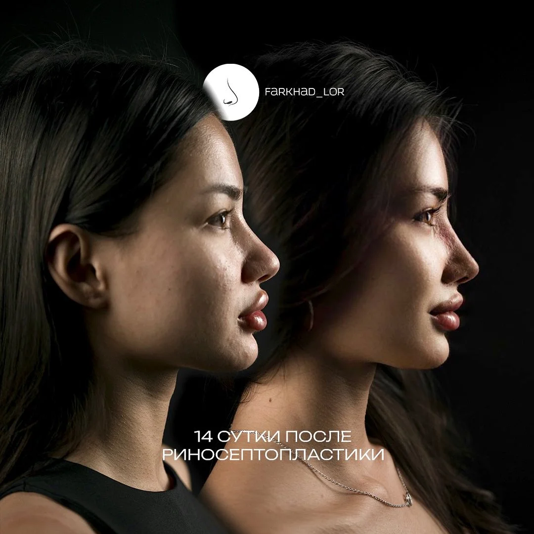 Повторная септопластика в Астане и Алматы: когда имеет смысл делать операцию ещё раз 3 Риносептопластика: цена в Казахстане, показания, сочетание функциональной и эстетической коррекции, как устранить повторное искривление носовой перегородки.