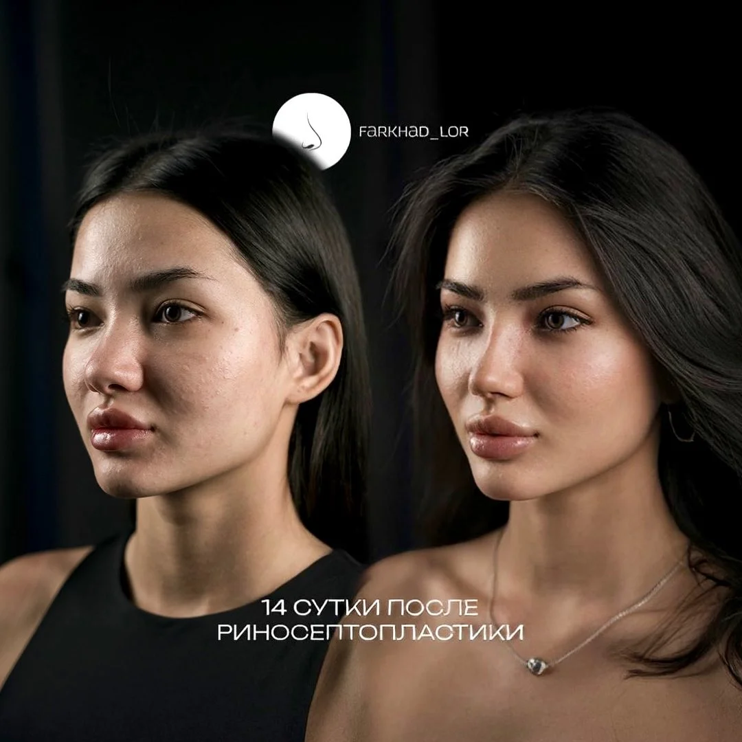 Повторная септопластика в Астане и Алматы: когда имеет смысл делать операцию ещё раз 2 Повторная септопластика в Астане и Алматы: что делать при повторном искривлении носовой перегородки, как проходит ресептопластика и от чего зависит итоговая стоимость.