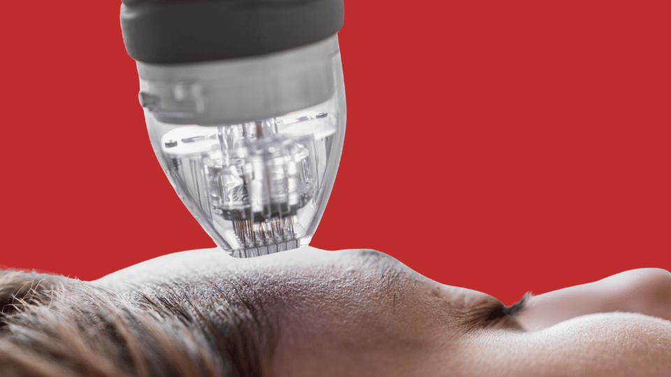 Микроигольчатый RF-лифтинг INUS: лицо, шея, декольте. Показания, этапы, реабилитация и цена в Tulip Medicine.RF-лифтинг Алматы: лифтинг-эффект без операции. Разбираем ожидания, риски и что важно спросить у врача перед процедурой.