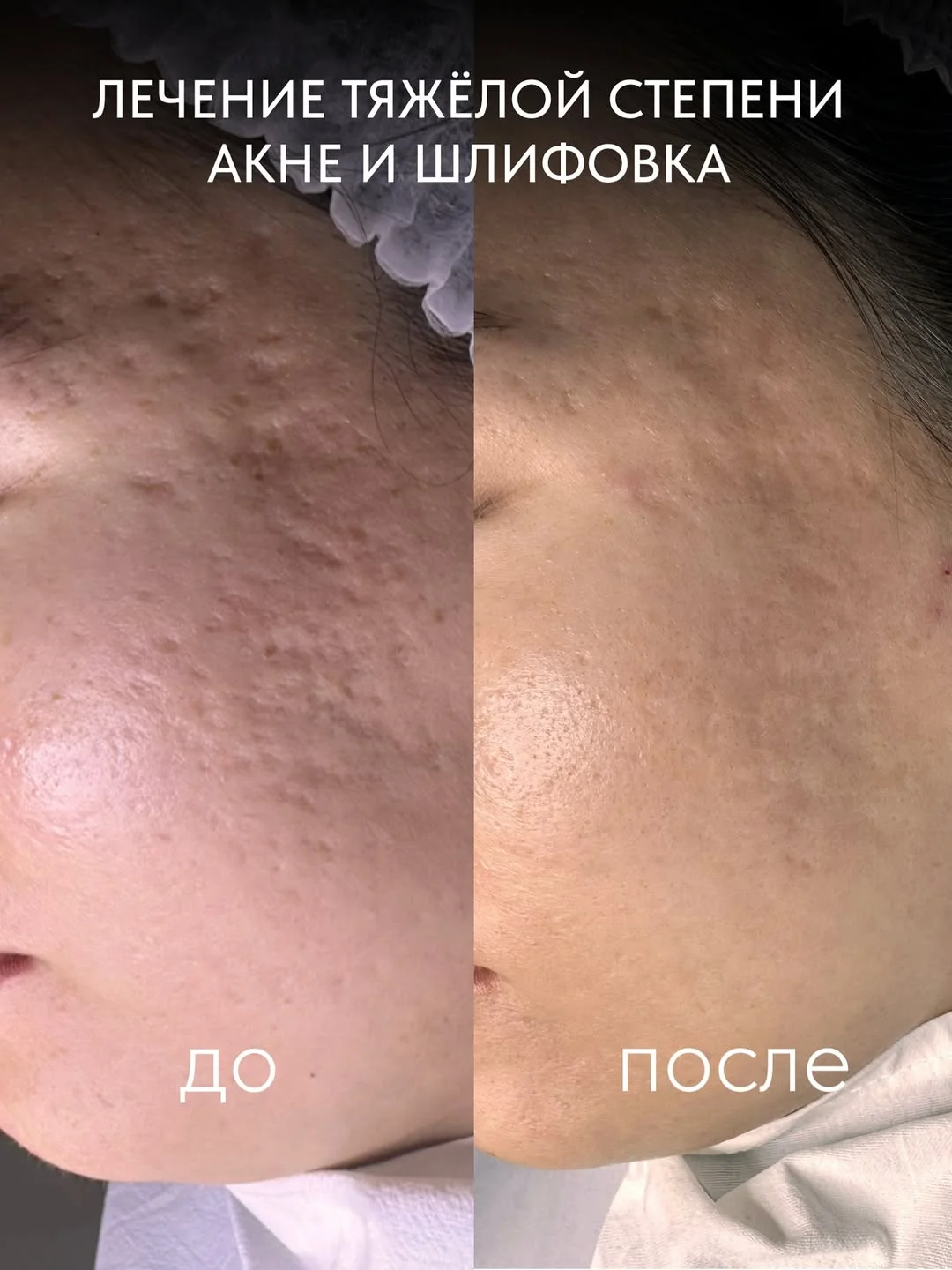 Лазерная шлифовка в Астане — гладкая кожа после акне 3 Лазерная шлифовка в Астане сокращает постакне, растяжки и послеоперационные рубцы, включая шрам после кесарева. 1–3 сессии с интервалом 4–8 недель.