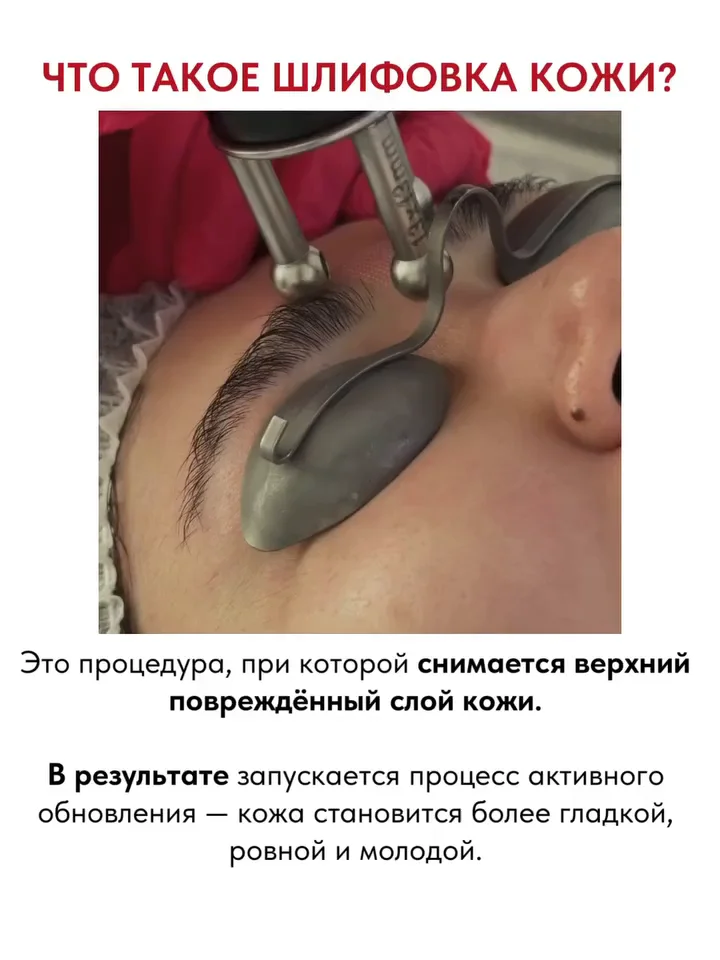 Лазерная шлифовка в Астане — гладкая кожа после акне 1 Лазерная шлифовка в Астане на Grand Cell CO₂ помогает при глубоких постакне-рубцах и шрамах. Контролируемая абляция, стимуляция коллагена, видимый эффект.