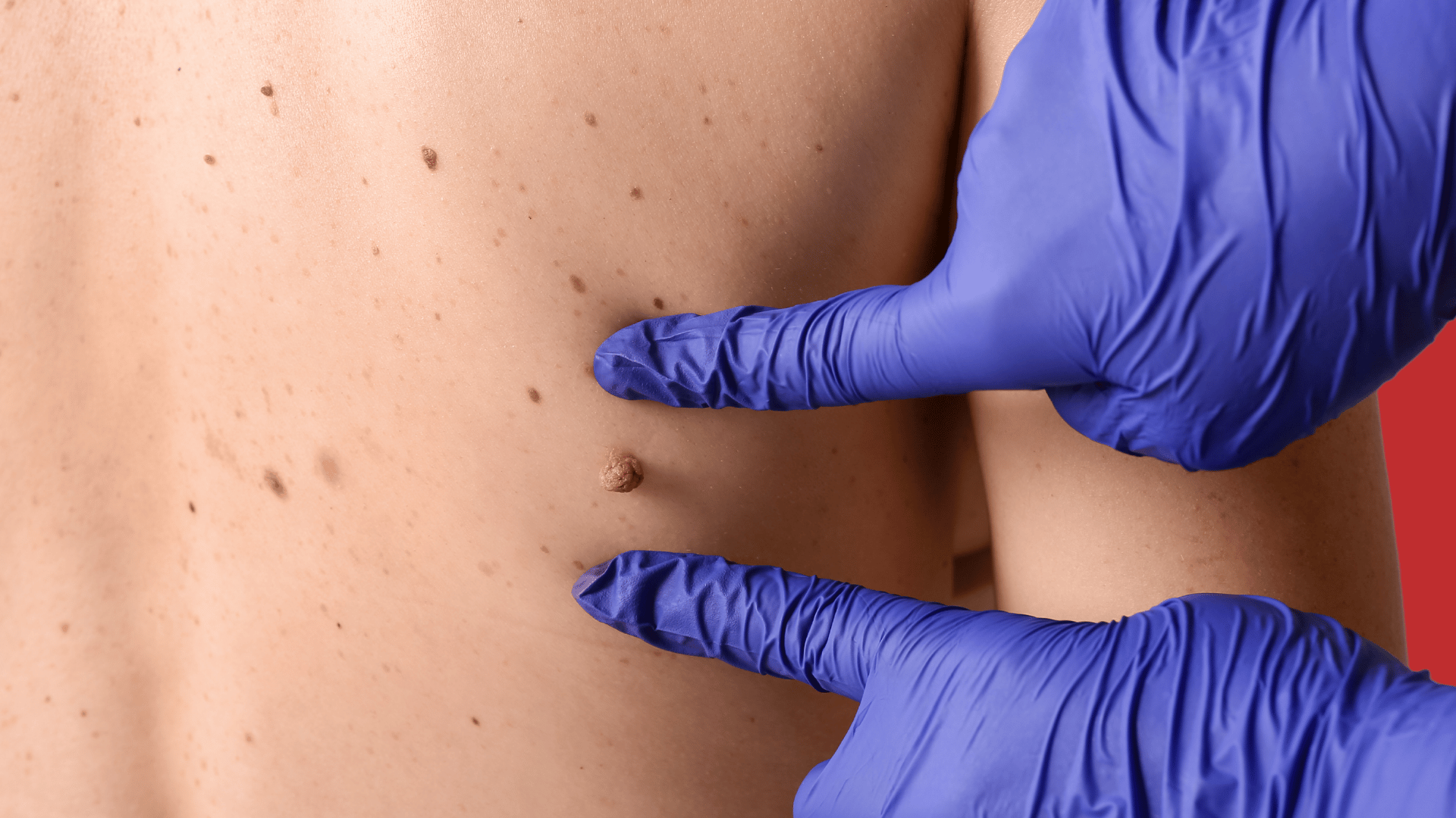 Удаление родинок на спине в Астане: безопасно, точно, с контролем результата 1 Удаление родинок на спине в Астане под контролем врача. Диагностика, выбор метода и аккуратный шов. Прозрачная смета и постуход.