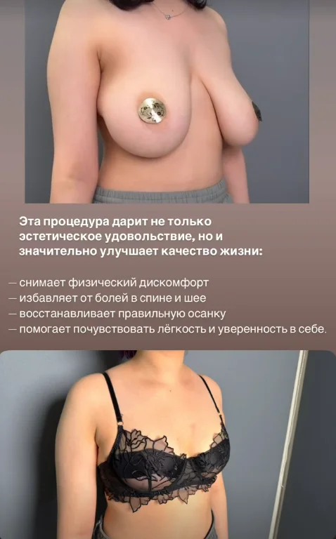 Уменьшение груди (редукционная маммопластика) в Астане: когда эстетика становится вопросом здоровья 3 Как уменьшить грудь и на сколько размеров это возможно безопасно? Редукционная маммопластика в Астане с учётом пропорций и здоровья.