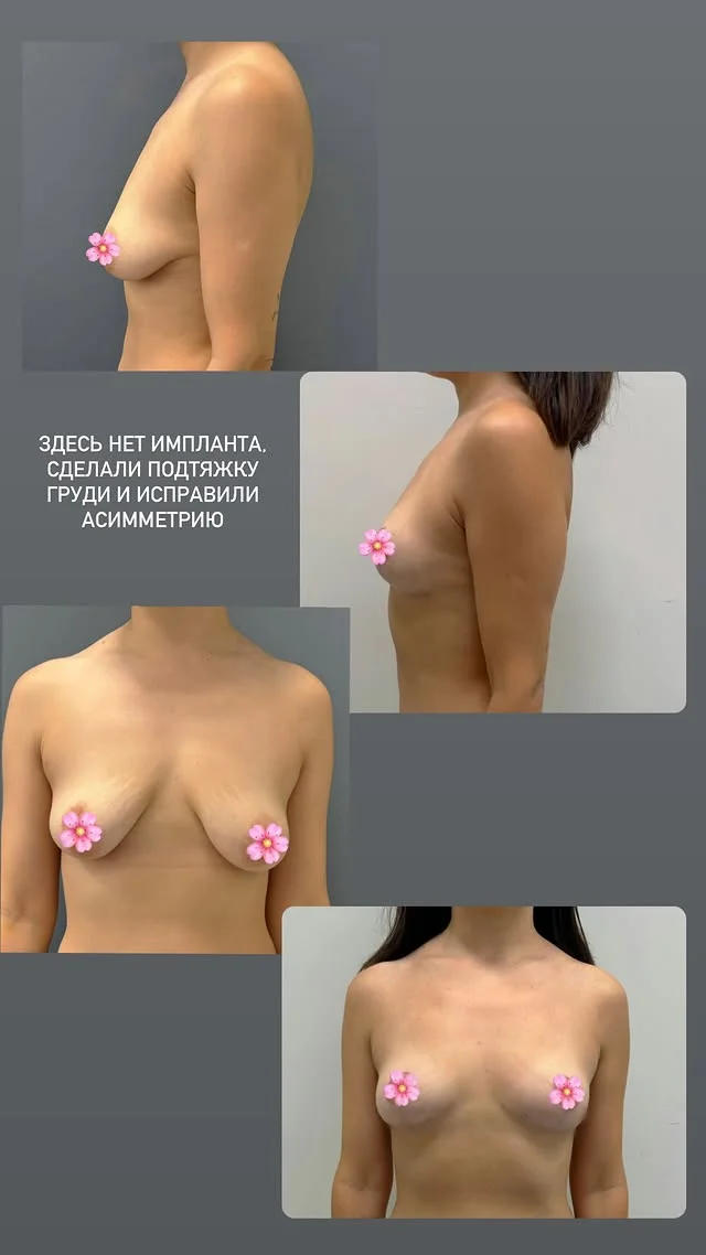 Уменьшение груди в Астане: операция, отзывы, 5 фото до-после