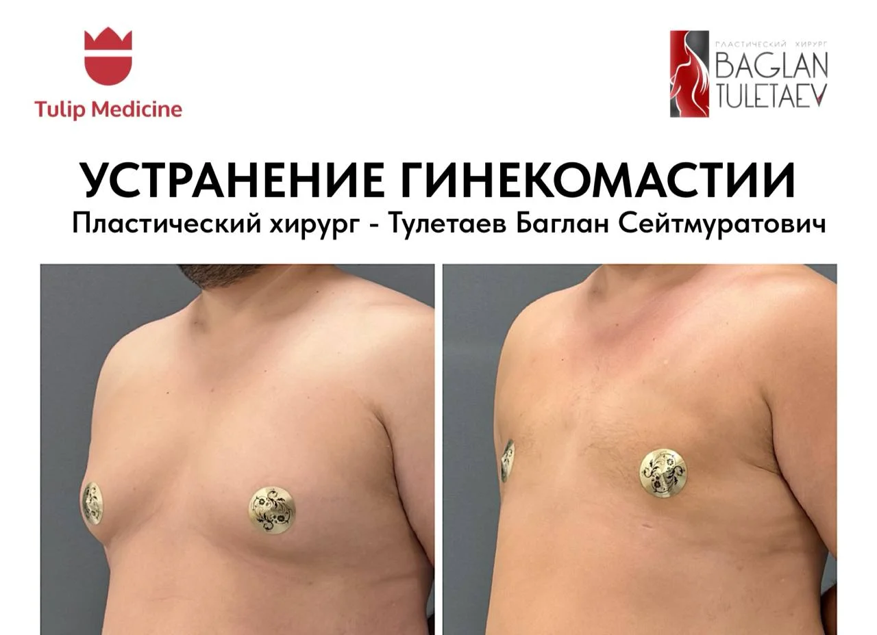 Устранение гинекомастии у мужчин в Tulip Medicine: цена от 600 000 ₸, консультация хирурга, фото до и после и реабилитация.