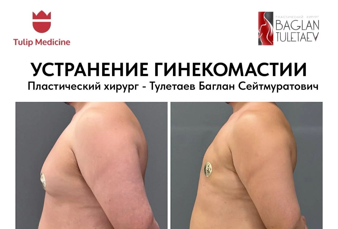 Лечение истинной и ложной гинекомастии в Астане. Узнайте стоимость операции, показания, этапы подготовки и особенности восстановления.